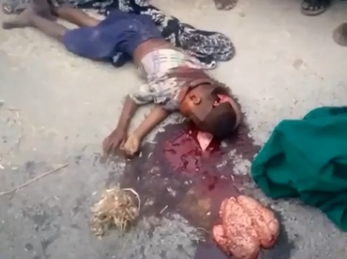 Entire Brain Ejected From Boy's Head..