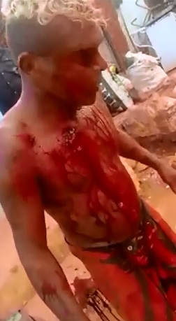 Sliced Open by a Broken Bottle 