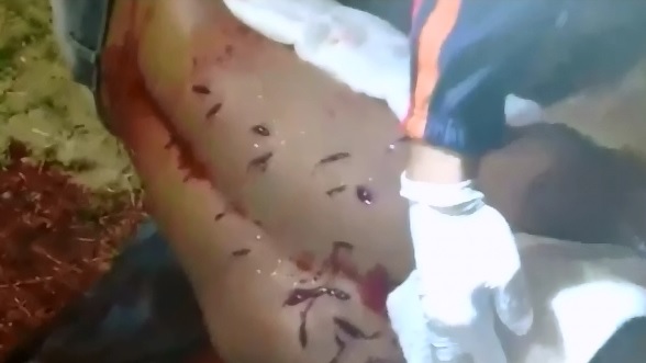 Man Resembling a Pin Cushion is Still Alive after Brutal Stabbing 