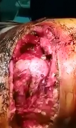 Horrible Chest Trauma Heart Beating out of the Chest 