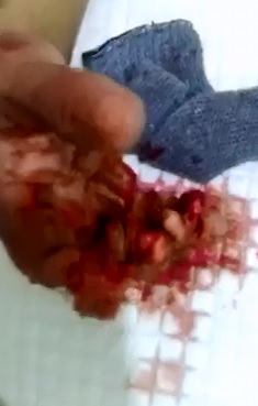 These Fingers were Destroyed by Industrial Machine 