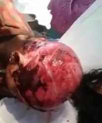 Woman totally Scalped to the Bone receives Medical Care