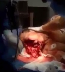 Hard to Watch video of Man Failed Suicide still Mumbling to Doctors and Nurses 