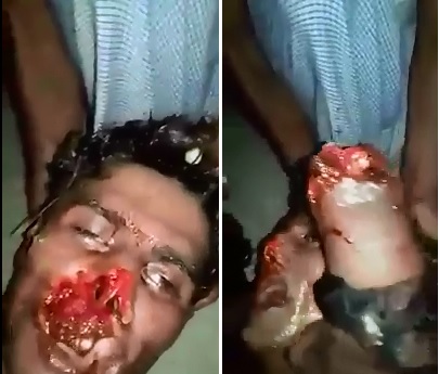 Man's Nose, mouth and Arm All Cut Off from Machete Attack..Still Alive 