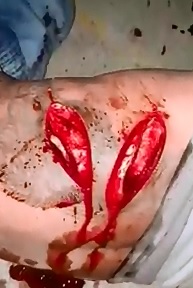 Breathing Wounds..Wide Open Gashes from a Machete Attack 