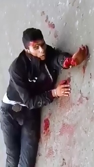 Mans Hand Dangling by Tendons begs for Help on the Street .. 