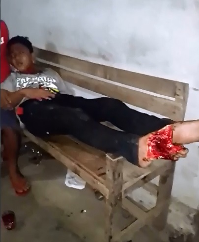 Bad Mistake..Foot left on the Train Tracks is a Foot No Longer There 