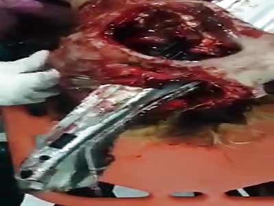 Car accident survivor in Mexico City