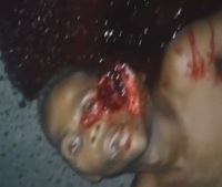 Teenager Disfigured by Shot to the Face