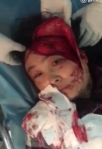 WHOA! Womans Scalp Ripped Off