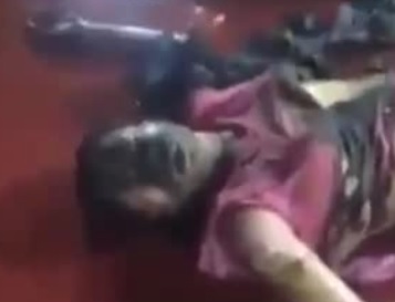 Girl in Agony After Being Severely Burned by Jealous Boyfriend with gasoline