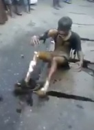 Depressed Man Burns Himself after Bad Breakup with GF