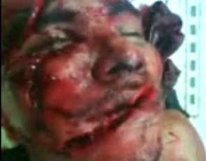 Man Hacked with Machete Blows Still Talking