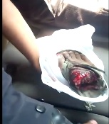 Guy making jokes holding his severed foot in the way to the hospital