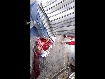 Man With His Legs Ripped Right off in Shock Waiting for Help