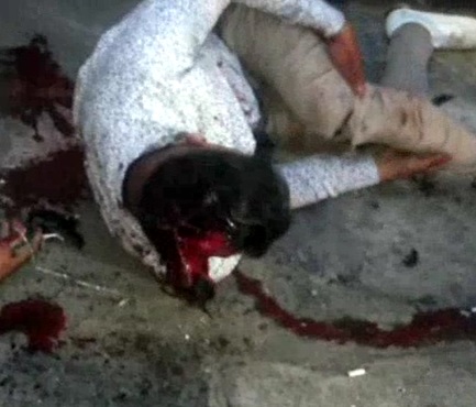 OUCH! Dude Scalped From Accident and Both Legs Snapped