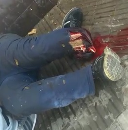 Dudes Leg Ripped Apart after Motorcycle Accident