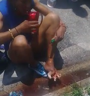 Girl with a FUCKED Up Foot