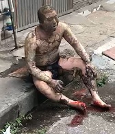 Dude Escapes House Fire But is Burned to Shit