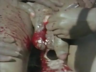 Deep Circumcision for 