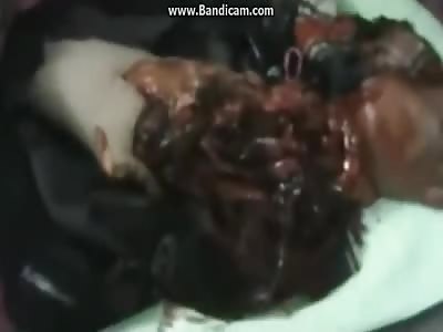 Young girl with destroyed arm.