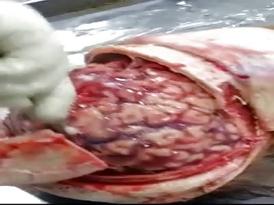 Removing the brain from a corpse