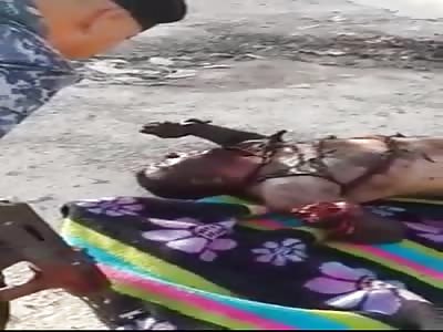 Civil badly wounded after being hit by a bombing in Syria.