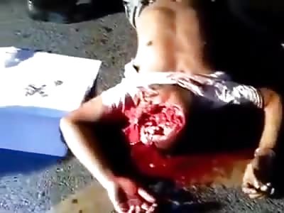 Face disfigured in an accident