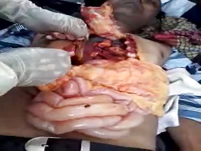 Suicidal man in the morgue, Necropsy