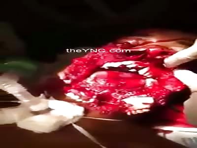 Man with his disfigured face after being shot