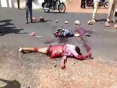 The Man Still Alive With A Severed Leg In Accident