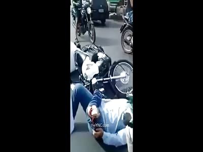 Motorcyclist With Fracture Exposed In His Knee