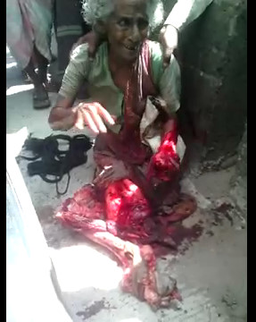 Old Woman With Her Arm And Both Legs Cut Off By A Truck