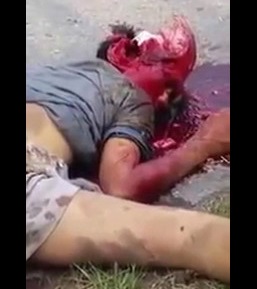 Busted Skull of a Pedestrian Hit by a Bus