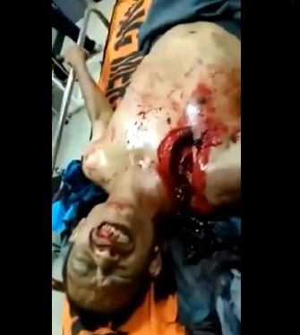 Man Squirming in Pain with His Shoulder and Chest Wide Open After Machete Attack