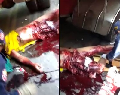 The Motorcyclist With Horrific Injuries After Being hit By Truck