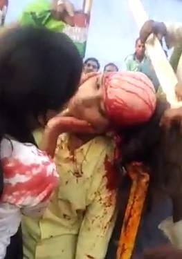 SHOCK: Girl Was Horribly Scalped and Friend Conforts Her .