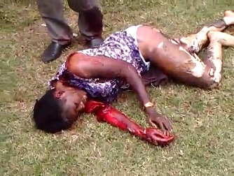 Woman Severely Burned and With Arm Almost Ripped Off waits for Help