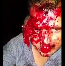 Drunk Man With Face Skinned Just Wants an Ambulance