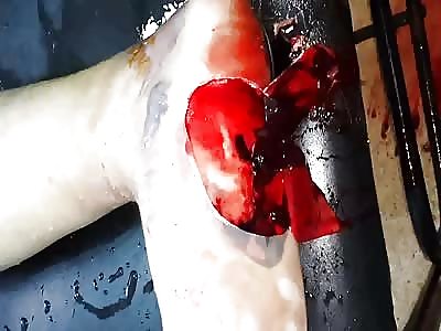 SOLDIER WITH DEEP FOOT INJURY DIE FOR NOT SEEK MEDICAL CARE