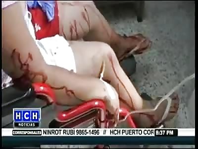 GIRL WAS ALMOST KILLED BY A COATI