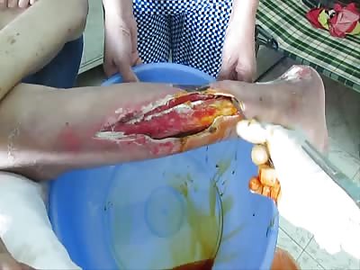 KEEPING CLEAN THE WOUNDS