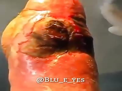 GANGRENE AND AMPUTATION