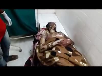 HALF NAKED WOMAN IN PAIN AFTER ATTEMPTING SUICIDE SETTING HERSELF ON FIRE