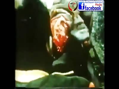 ANCIENT AND SHOCKING VIDEO OF NEUROSURGERY IN AFRICA