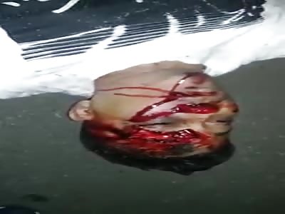 HAND DESTROYED IN AN ACCIDENT