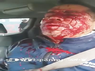 HE BROKE HIS FACE IN AN ACCIDENT