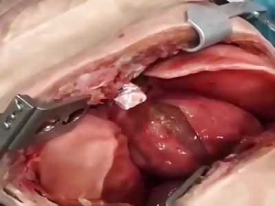 OPEN CHEST AND WOUNDED HEART