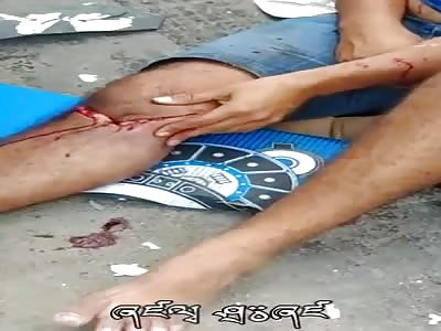 LEG FRACTURED IN ACCIDENT