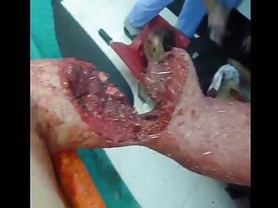 ARM ALMOST RIPING OFF